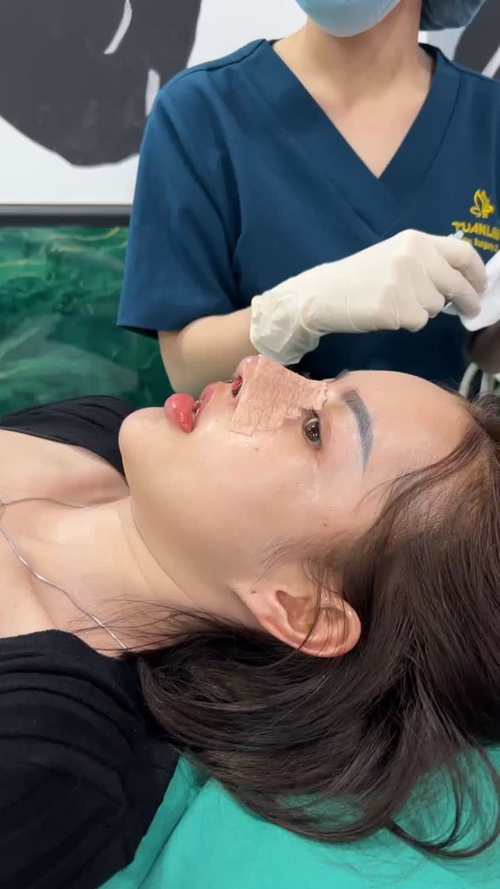 Nâng mũi cấu trúc sửa lại sau 2 ngày tháo gạc mũi